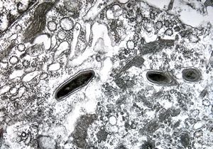 Whipple disease Whipple disease